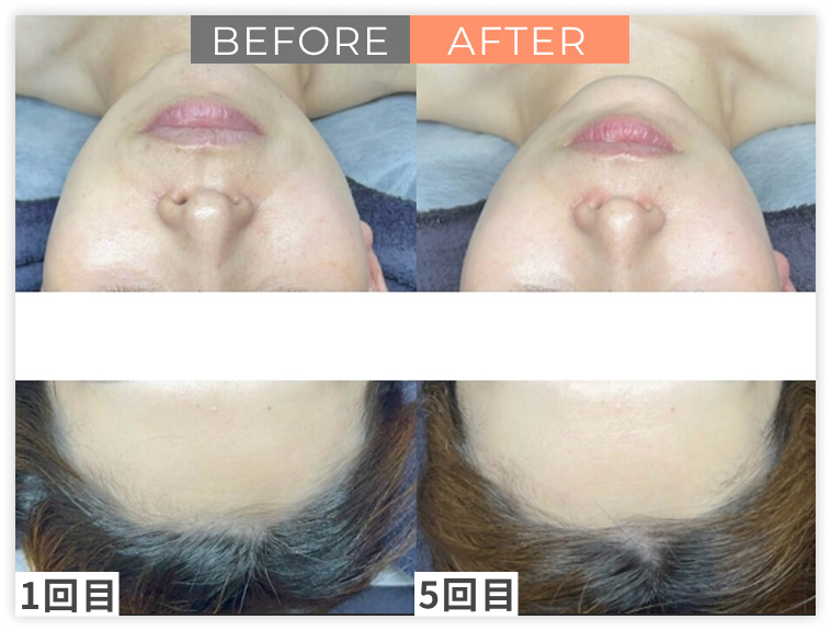 ララピール×LDMのビフォー/アフター